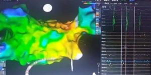 إدخال خدمة علاج مرضى الذبذبة الأذينية بتقنية جديدة في مستشفى القلب الجامعي بأسيوط - بوابة فكرة وي