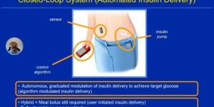وداعًا للإبر.. الكشف عن جهاز البنكرياس الصناعي لقياس السكر وقت النوم بالخبر - بوابة فكرة وي