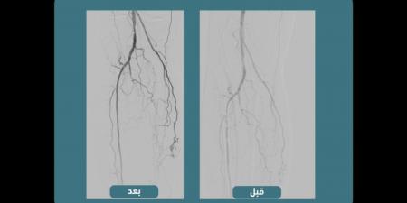 قسطرة الشرايين الطرفية تنقذ مرضى القدم السكرية من البتر في الرياض - بوابة فكرة وي