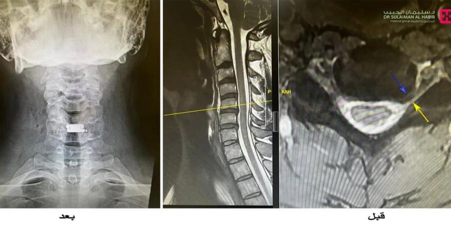 مستشفى الدكتور سليمان الحبيب بالسويدي يجري جراحة لاستبدال غضروف الرقبة وتوسيع القناة الشوكية لمراجع أرجنتيني - بوابة فكرة وي