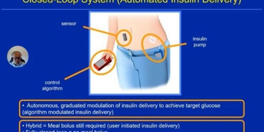 وداعًا للإبر.. الكشف عن جهاز البنكرياس الصناعي لقياس السكر وقت النوم بالخبر - بوابة فكرة وي
