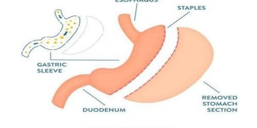 ما هي أضرار عملية تحويل مسار المعدة على المدى البعيد؟ دكتور أسامة خليل - بوابة فكرة وي
