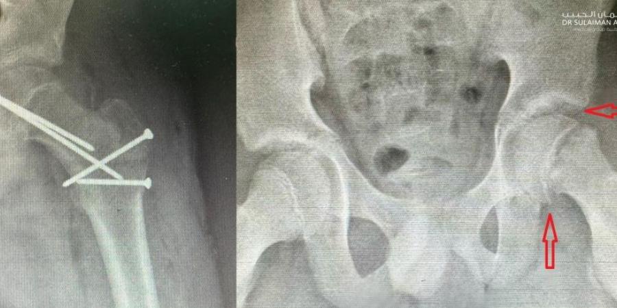 مستشفى الدكتور سليمان الحبيب بالخبر ينجح بإعادة قدرة المشي لطفل يعاني من انزلاق غضروفي نادر بالورك - بوابة فكرة وي