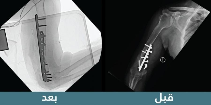 "سعود الطبية" تنهي معاناة استمرت 19 عامًا لمريض فقد حركة الكوع - بوابة فكرة وي